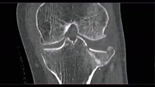  膝关节外伤后胫骨平台骨折，CT检查发现了什么与众不同？
